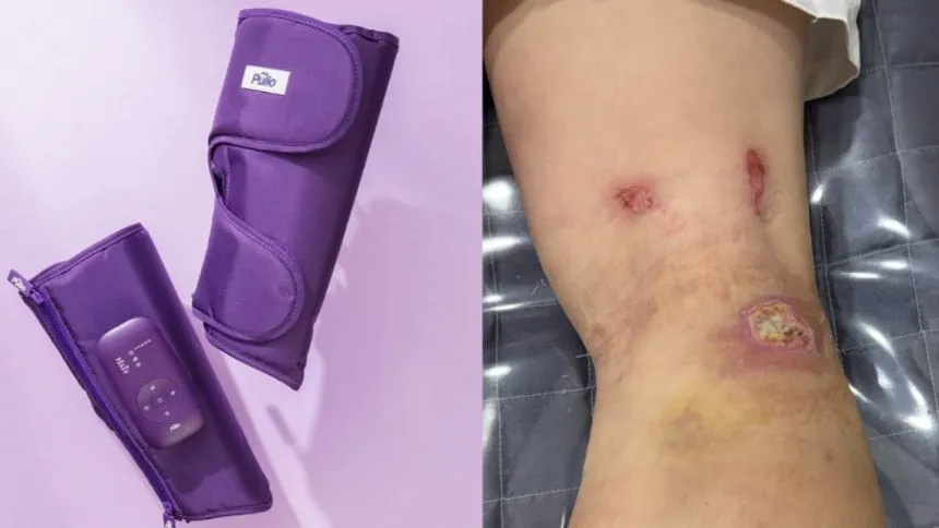 “저온 화상으로 흉터 생겨” 치료비 요구했지만...풀리오 “보상 못해” 갈등